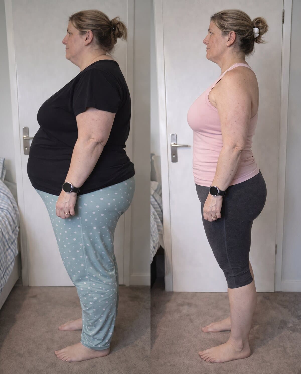 Vorher-Nachher-Transformation im Seitenprofil einer Kundin, flacherer Bauch