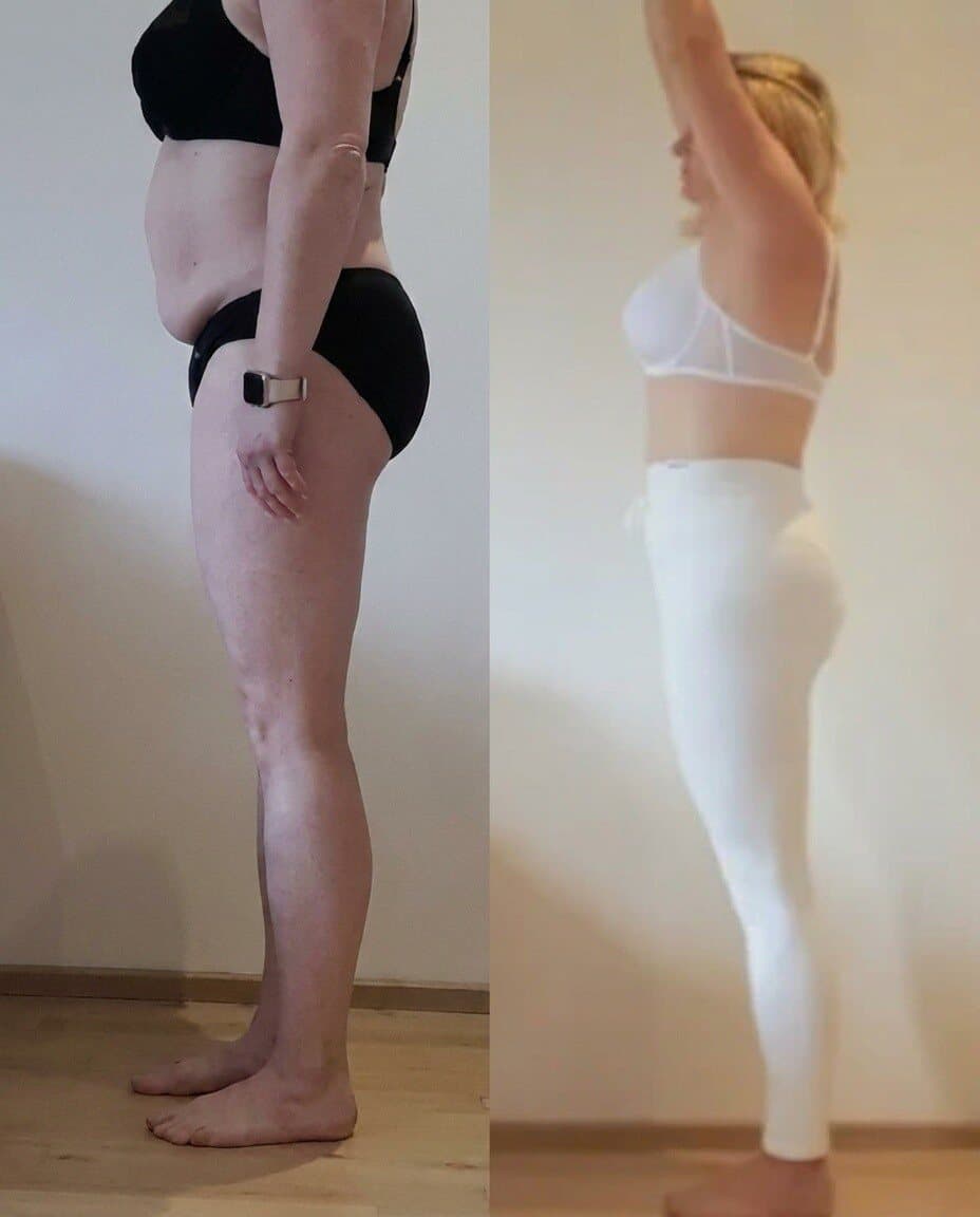 Vorher-Nachher-Transformation im Seitenprofil einer Kundin, sichtbar definierter